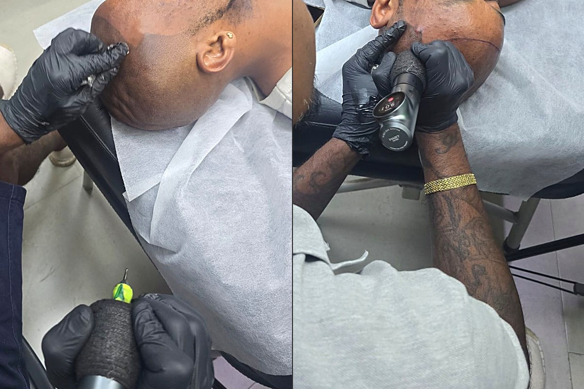 Scalp micropigmentation at Glamour Tattoo Studio, Grand Baie: an artist applying pigment along a client's hairline